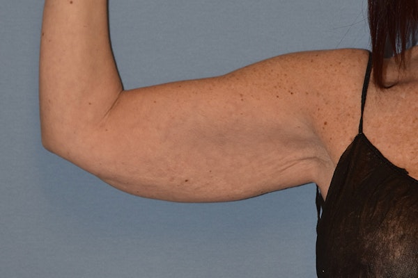 Arm Lift Before & After Gallery - Patient 413472 - Image 3