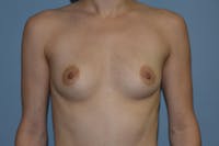 Breast Augmentation Before & After Gallery - Patient 122839 - Image 1