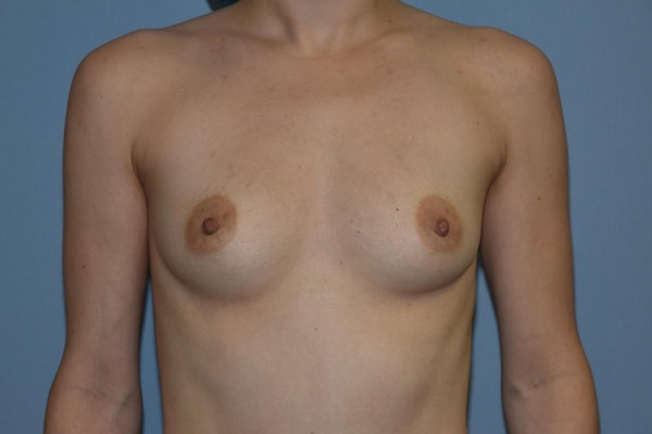 Breast Augmentation Before & After Gallery - Patient 122839 - Image 1