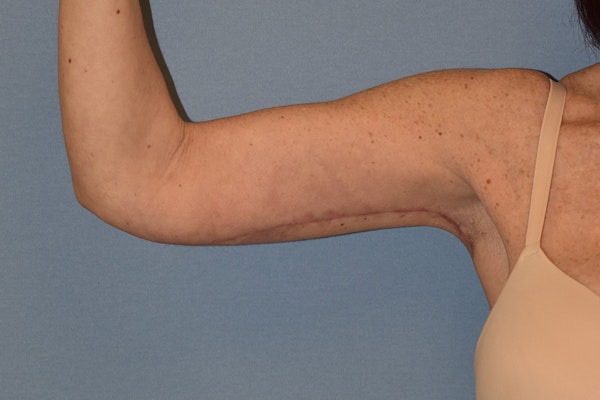Arm Lift Before & After Gallery - Patient 413472 - Image 4