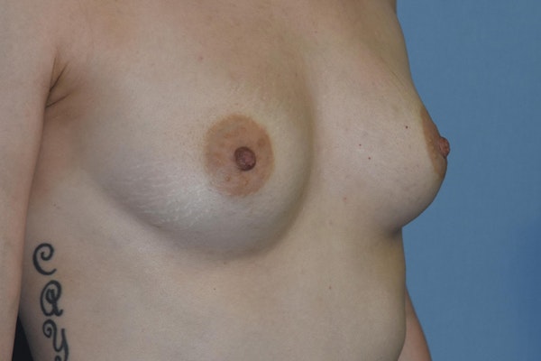 Breast Augmentation Before & After Gallery - Patient 122839 - Image 3