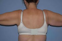 Arm Lift Before & After Gallery - Patient 318860 - Image 1