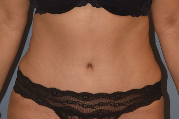 Liposuction Before & After Gallery - Patient 394556 - Image 2