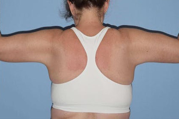 Arm Lift Before & After Gallery - Patient 318860 - Image 2