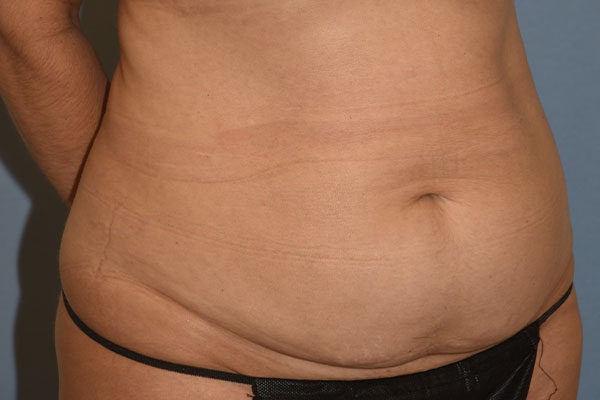 Liposuction Before & After Gallery - Patient 394556 - Image 3
