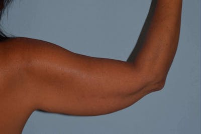 Arm Lift Before & After Gallery - Patient 347658 - Image 1