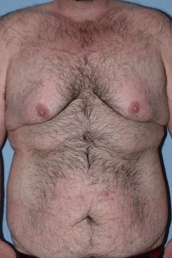 After Weight Loss Surgery Before & After Gallery - Patient 106343 - Image 1