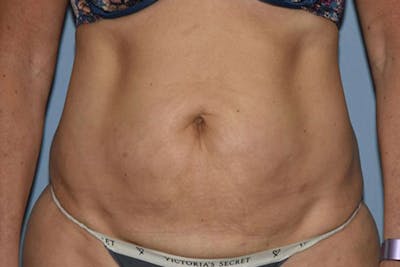 Tummy Tuck Before & After Gallery - Patient 358420 - Image 1
