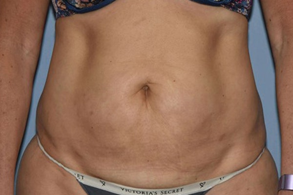 Tummy Tuck Before & After Gallery - Patient 358420 - Image 1