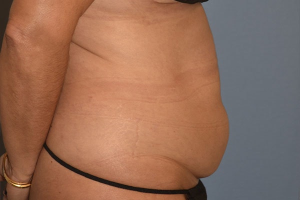 Liposuction Before & After Gallery - Patient 394556 - Image 5