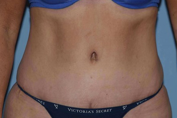 Tummy Tuck Before & After Gallery - Patient 358420 - Image 2