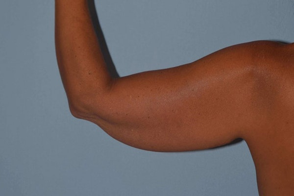Arm Lift Before & After Gallery - Patient 347658 - Image 3
