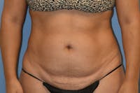 Liposuction Before & After Gallery - Patient 350131 - Image 1