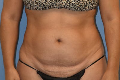 Liposuction Before & After Gallery - Patient 350131 - Image 1