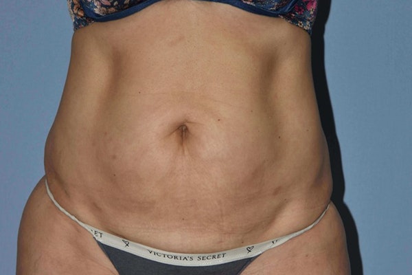 Tummy Tuck Before & After Gallery - Patient 358420 - Image 3
