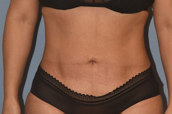 Liposuction Before & After Gallery - Patient 350131 - Image 2