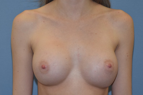 Breast Augmentation Before & After Gallery - Patient 159413 - Image 2