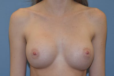 Breast Augmentation Before & After Gallery - Patient 159413 - Image 2