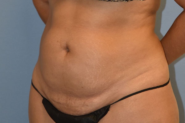 Liposuction Before & After Gallery - Patient 350131 - Image 3