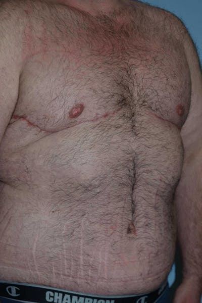 After Weight Loss Surgery Before & After Gallery - Patient 106343 - Image 4