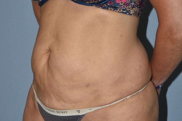 Tummy Tuck Before & After Gallery - Patient 358420 - Image 5