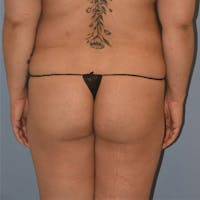 Brazilian Butt Lift Before & After Gallery - Patient 141656 - Image 1
