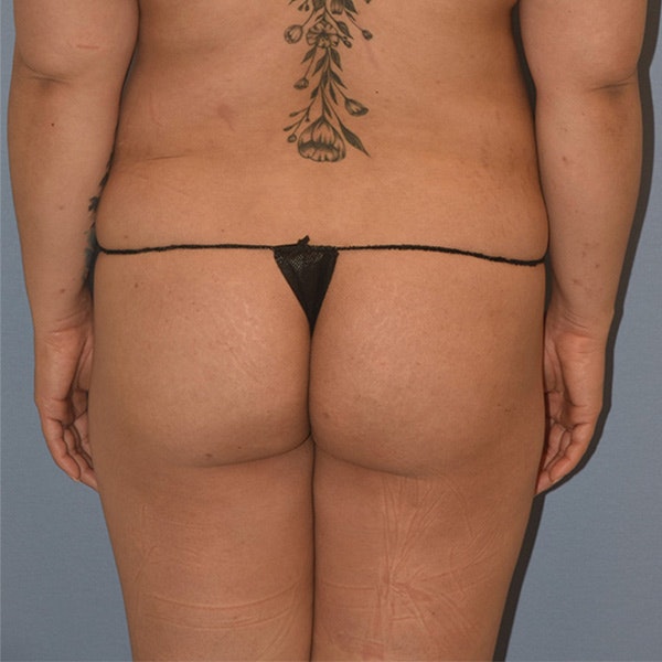 Brazilian Butt Lift Before & After Gallery - Patient 141656 - Image 1