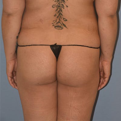 Brazilian Butt Lift Before & After Gallery - Patient 141656 - Image 1