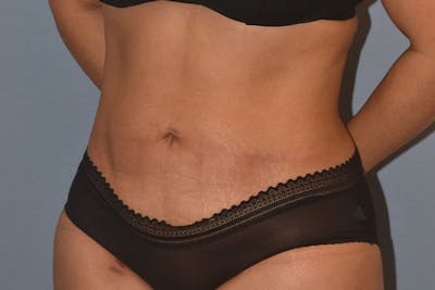 Liposuction Before & After Gallery - Patient 350131 - Image 4