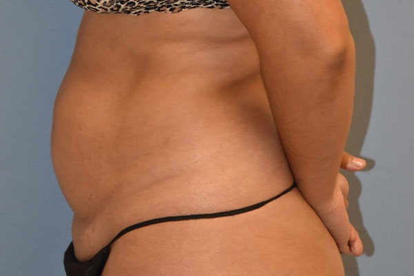Liposuction Before & After Gallery - Patient 350131 - Image 5