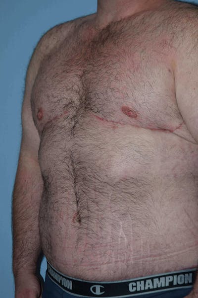 After Weight Loss Surgery Before & After Gallery - Patient 106343 - Image 6
