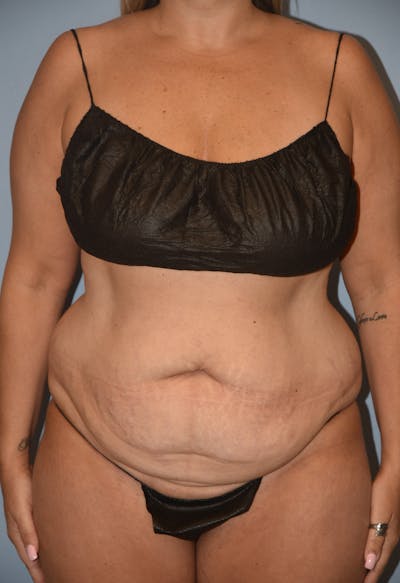 Tummy Tuck Before & After Gallery - Patient 393946 - Image 1