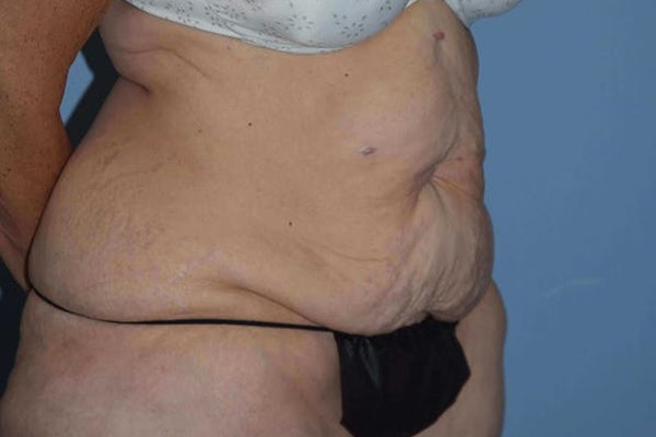 After Weight Loss Surgery Before & After Gallery - Patient 443794 - Image 3