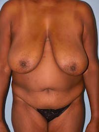 Mommy Makeover Before & After Gallery - Patient 241115 - Image 1