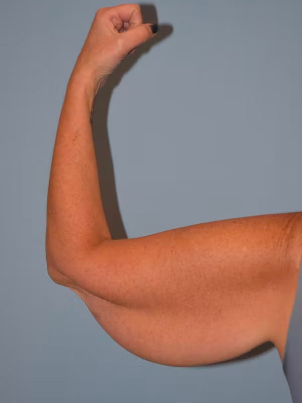Arm Lift Before & After Gallery - Patient 286914 - Image 3