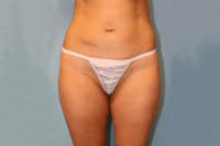 Liposuction Before & After Gallery - Patient 338823 - Image 1