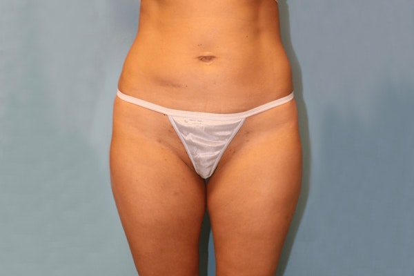 Liposuction Before & After Gallery - Patient 338823 - Image 1