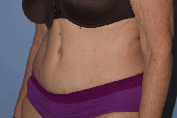 After Weight Loss Surgery Before & After Gallery - Patient 443794 - Image 8