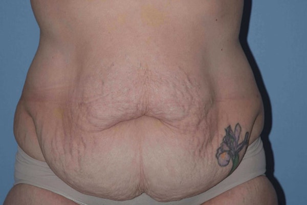 After Weight Loss Surgery Before & After Gallery - Patient 107798 - Image 1