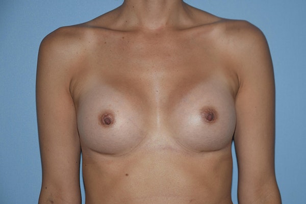 Breast Augmentation Before & After Gallery - Patient 137184 - Image 2
