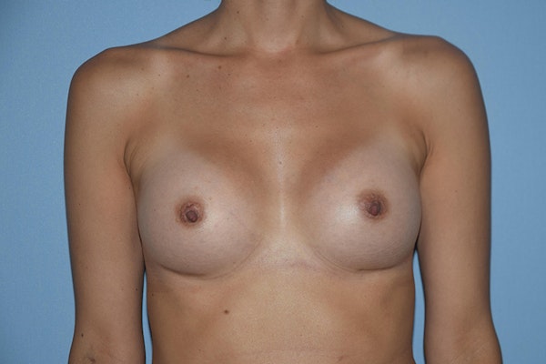 Breast Augmentation Before & After Gallery - Patient 137184 - Image 2