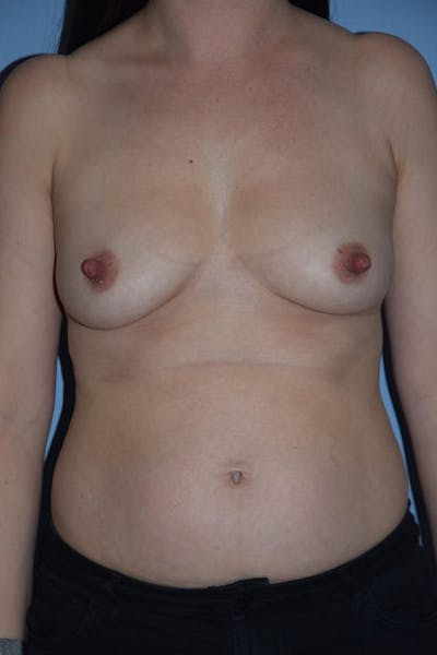 Mommy Makeover Before & After Gallery - Patient 240577 - Image 1