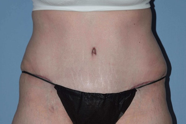 After Weight Loss Surgery Before & After Gallery - Patient 107798 - Image 2