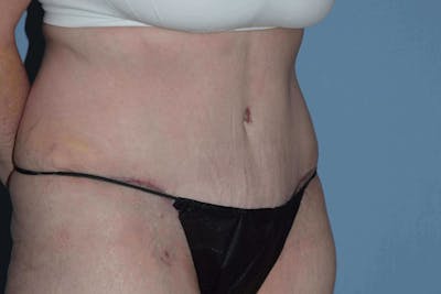 After Weight Loss Surgery Before & After Gallery - Patient 107798 - Image 4