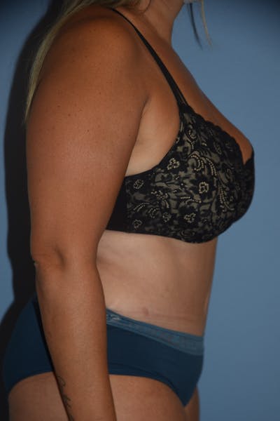 Tummy Tuck Before & After Gallery - Patient 393946 - Image 6