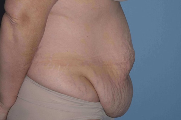 After Weight Loss Surgery Before & After Gallery - Patient 107798 - Image 5