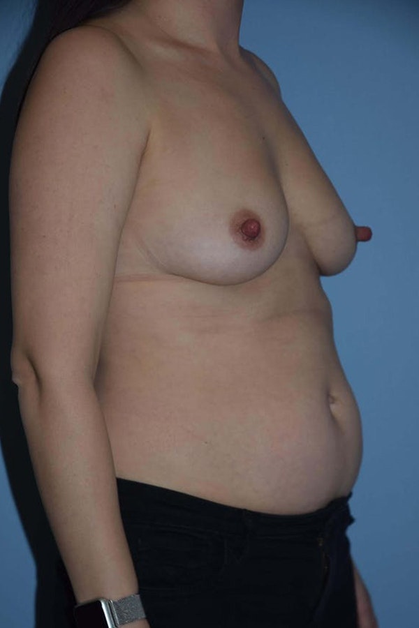 Mommy Makeover Before & After Gallery - Patient 240577 - Image 5