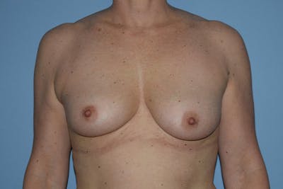 Breast Augmentation Before & After Gallery - Patient 204664 - Image 1