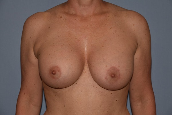 Breast Augmentation Before & After Gallery - Patient 204664 - Image 2