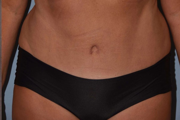 Tummy Tuck Before & After Gallery - Patient 251171 - Image 2